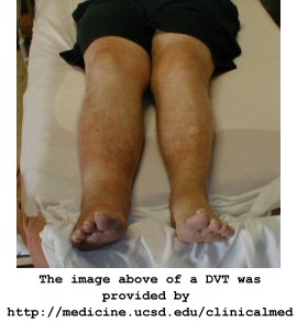 How Compression Therapy Supports Deep Vein Thrombosis Recovery